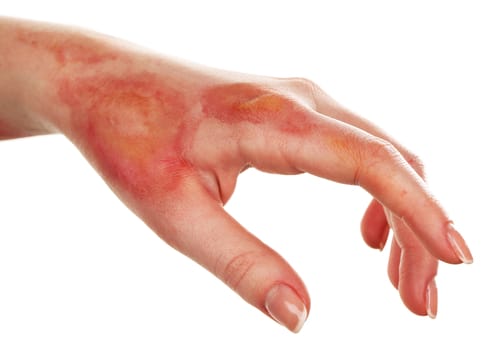 Burn Injury Lawyer in Queens NY - Settlement.jpg