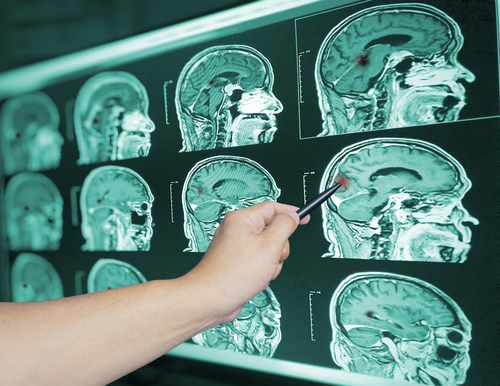 Brain Injuries Lawyer in Queens, NY | Book a Free Consultation