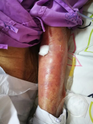 Stevens Johnson Syndrome Lawyer in NYC | Free Consultations